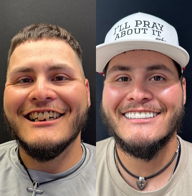 A Sonterra Dental patient before and after full-arch dental implants