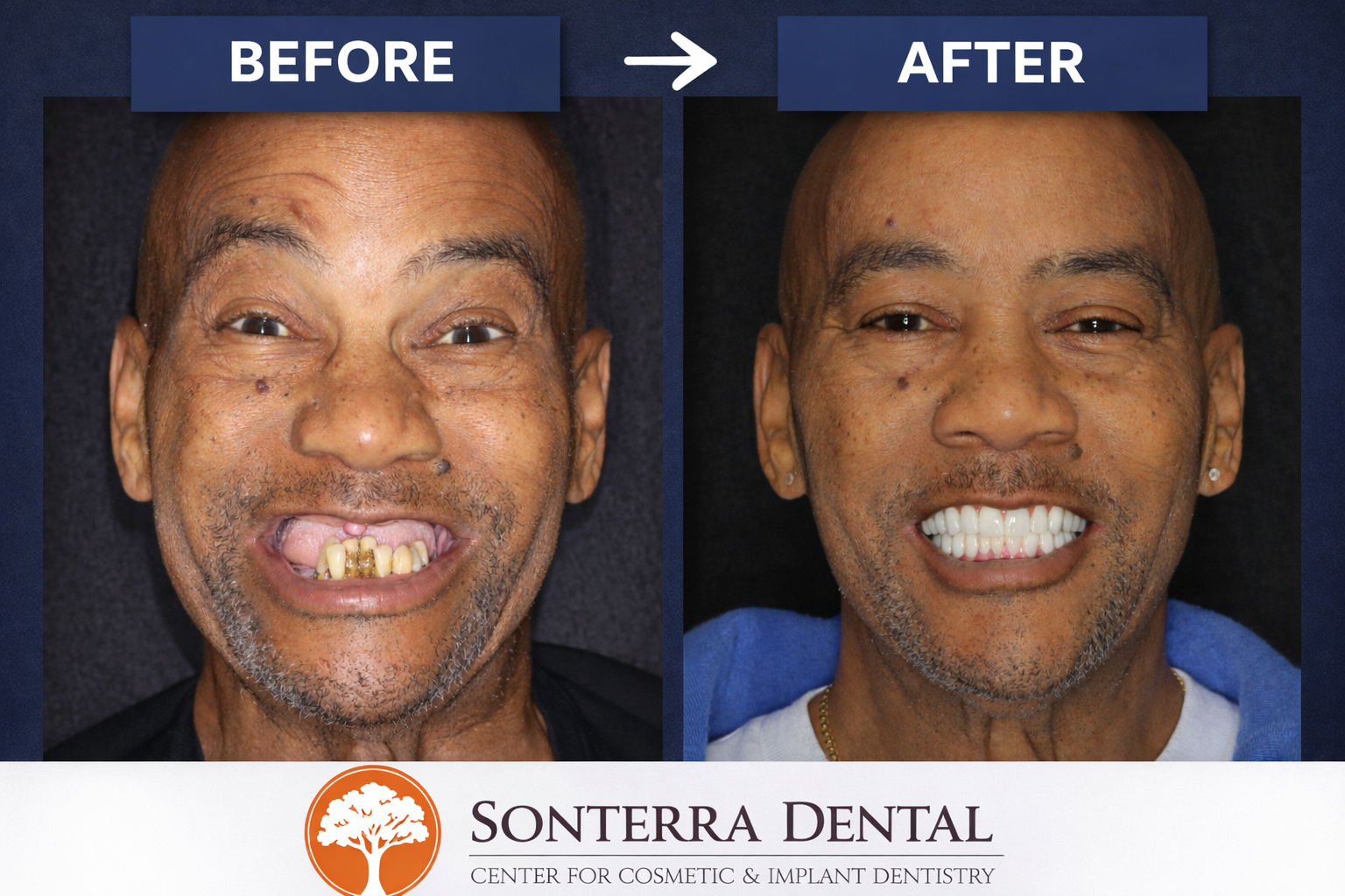 Full mouth All-On-X before and after — actual patient of Sonterra Dental