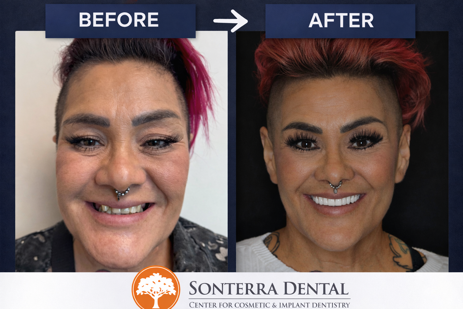 Full mouth All-On-X before and after — actual patient of Sonterra Dental