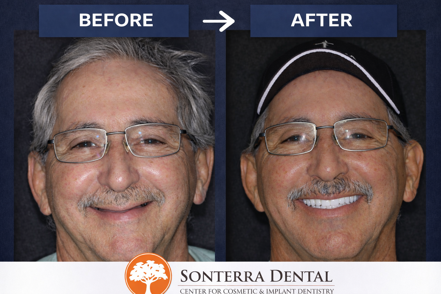 Full mouth All-On-X before and after — actual patient of Sonterra Dental