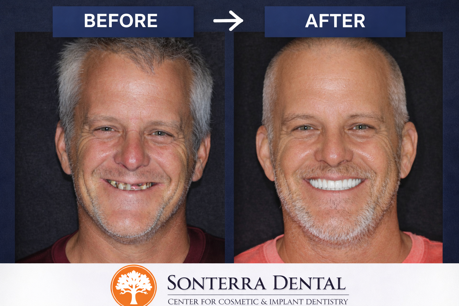Full mouth All-On-X before and after — actual patient of Sonterra Dental